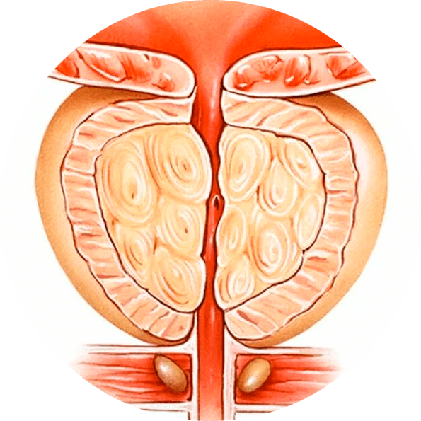 Consecuencias da prostatite non tratada