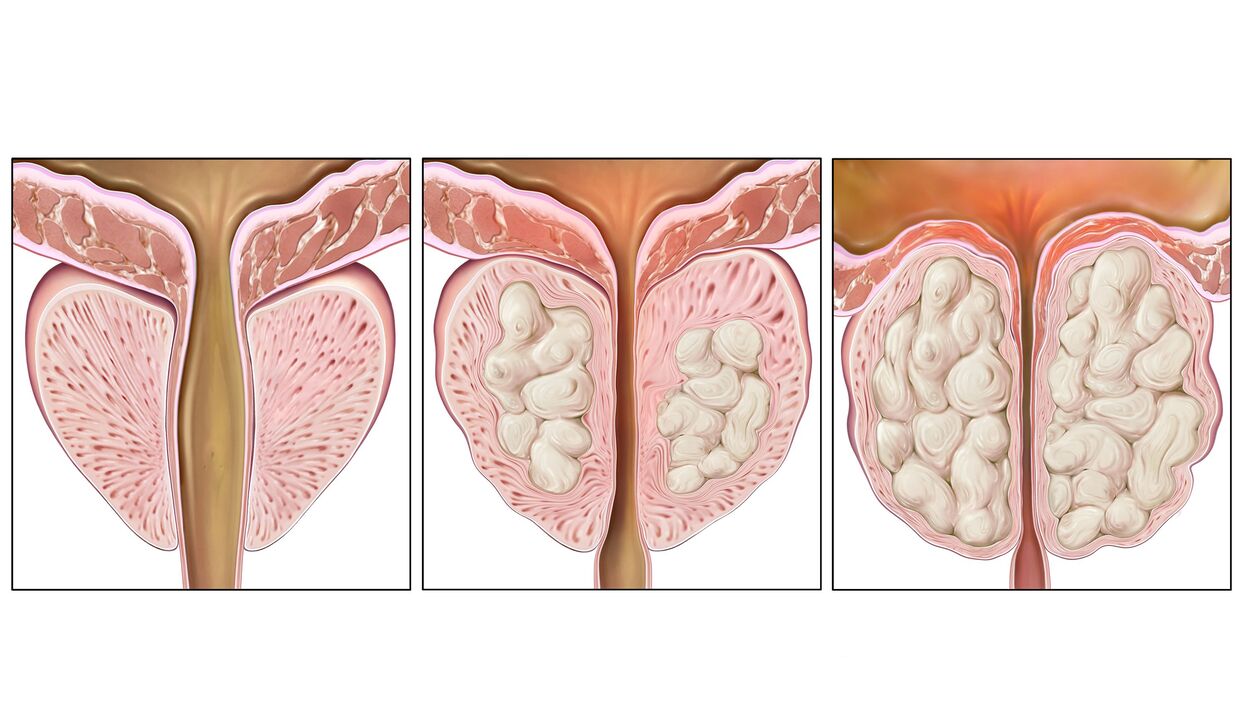 Etapas do cancro de próstata