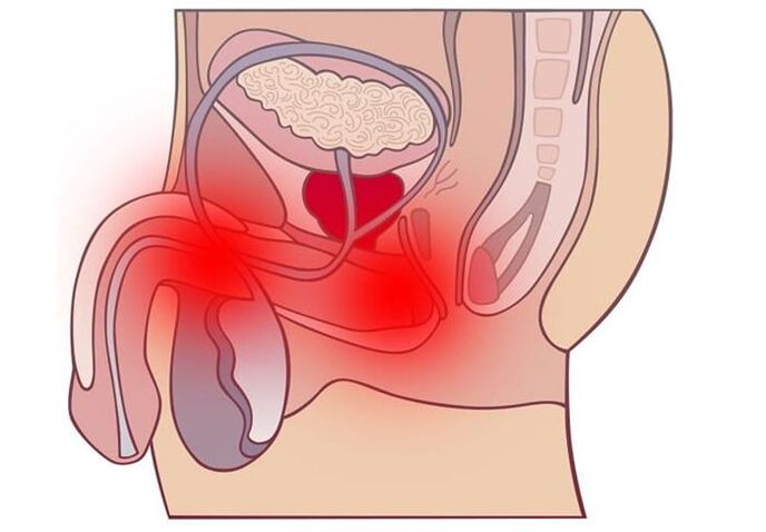 Métodos para tratar a prostatite