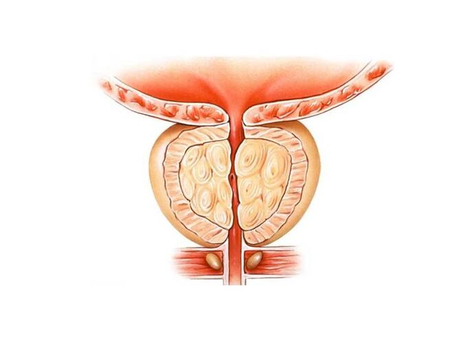 Tratamento da prostatite con remedios populares