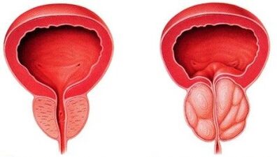 próstata sa e inflamada con prostatite